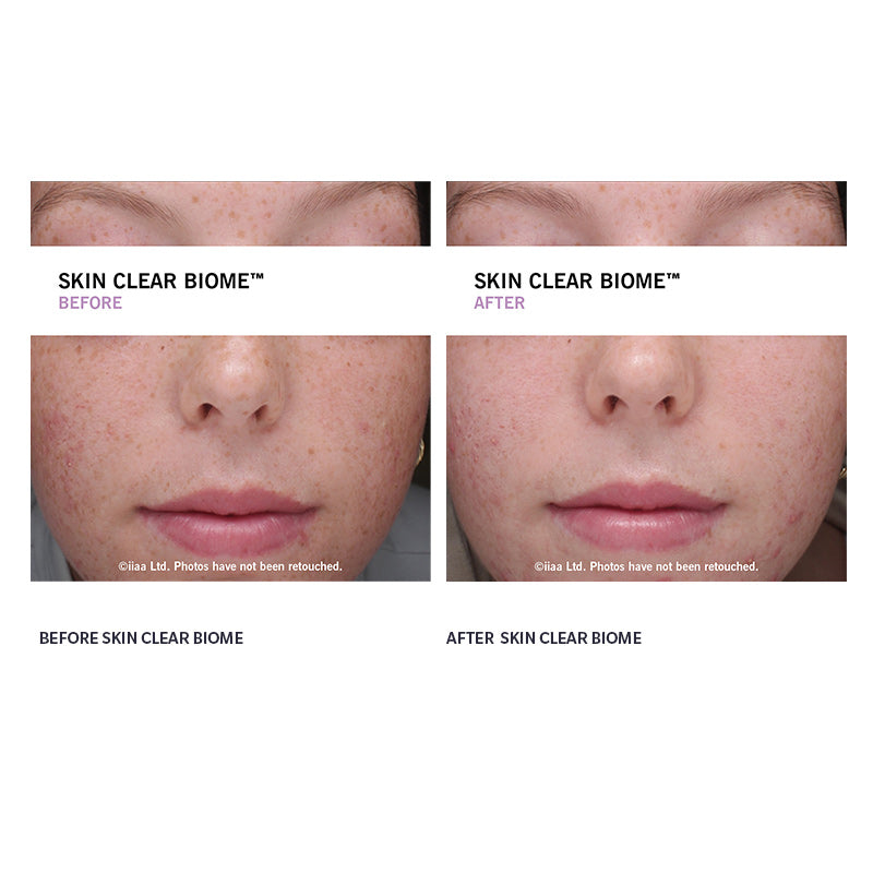 Skin Clear Biome 30 Day with Accumax